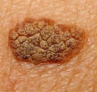 6 методов удаления новообразований на коже