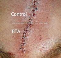 BTX-A в реконструктивной хирургии шрамов