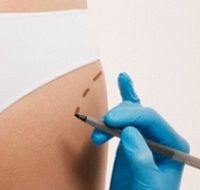 Упругие ягодицы и стройные ноги. Один хирургический штрих
